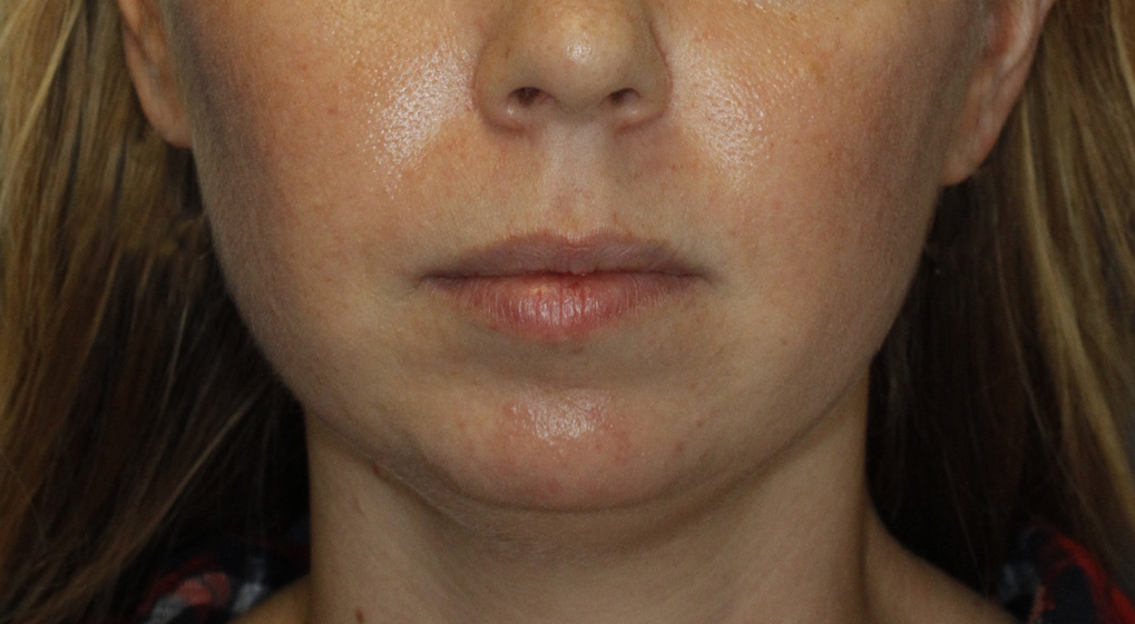 Chin Implant Before Frontal