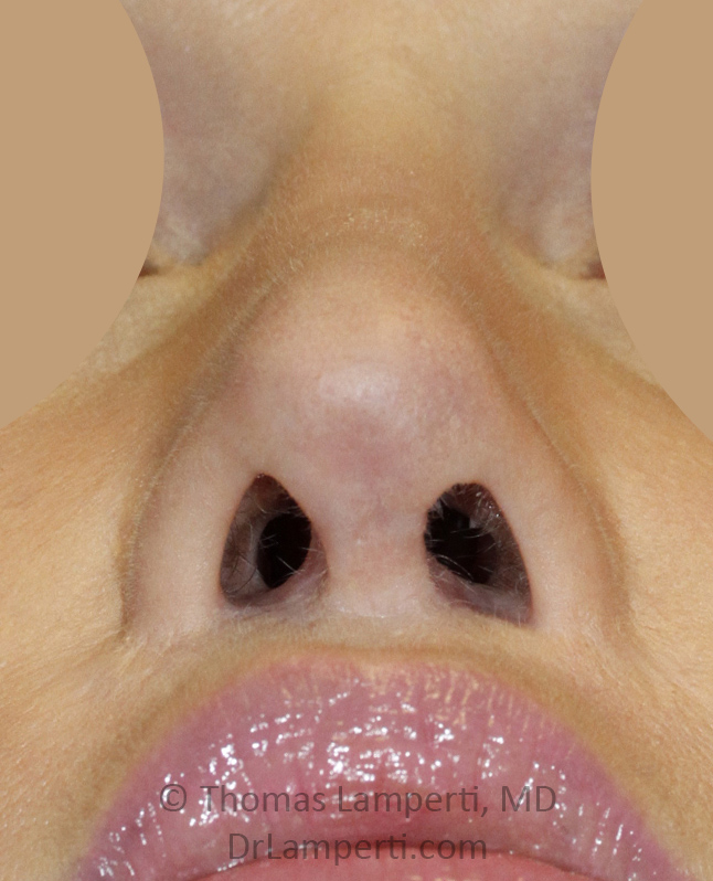 After Revision Rhinoplasty Base