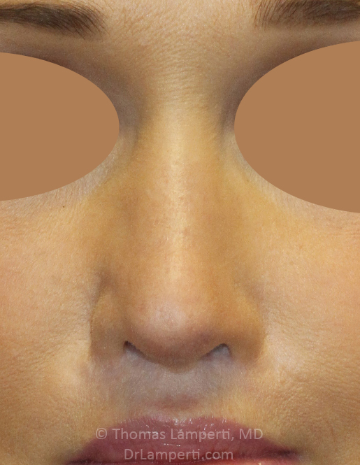 After Revision Rhinoplasty Frontal