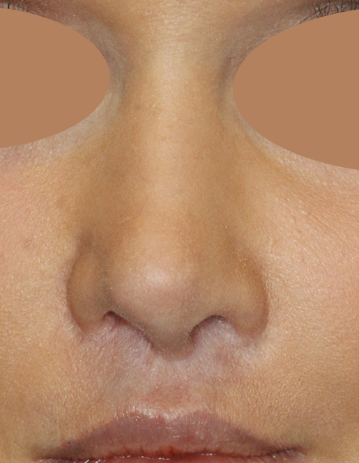 Before Revision Rhinoplasty Frontal