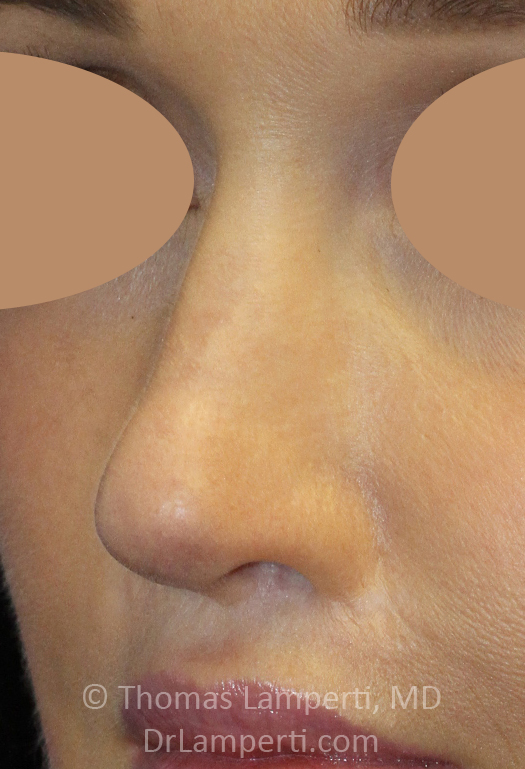 After Revision Rhinoplasty Left Oblique