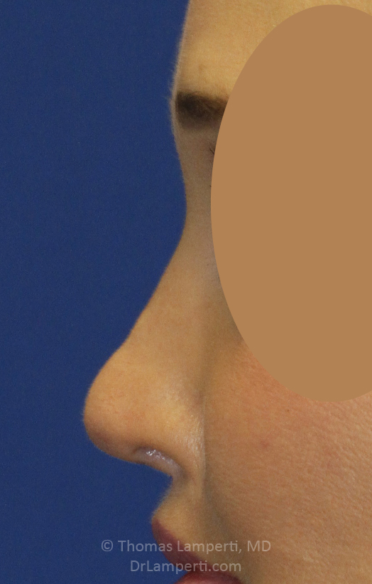 After Revision Rhinoplasty Left Profile