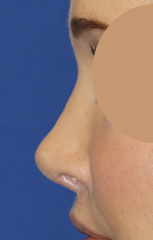 Before Revision Rhinoplasty Let Profile