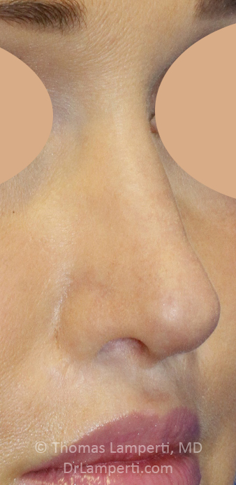 After Revision Rhinoplasty R Oblique