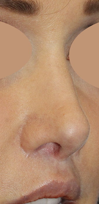 Before Revision Rhinoplasty Right Oblique