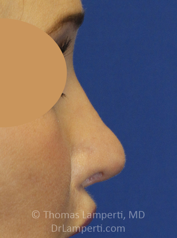 After Revision Rhinoplasty Right Profile