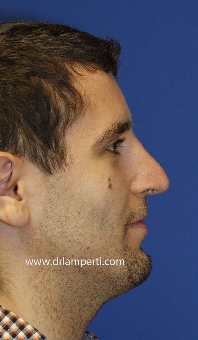 Revision Rhinoplasty Profile After