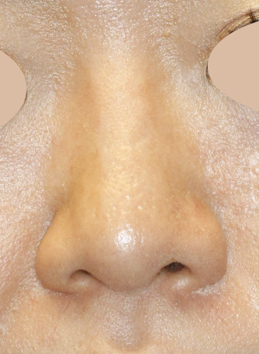 After Asian Rhinoplasty Frontal