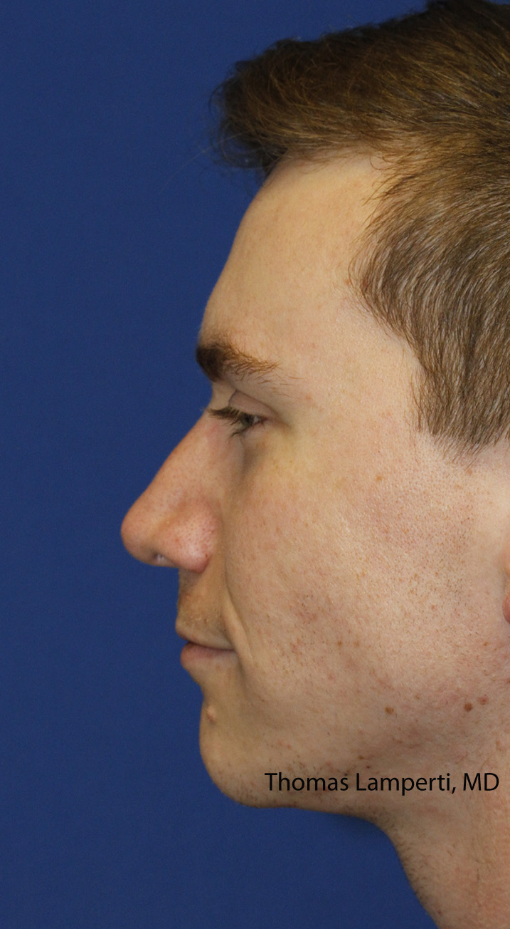 Rhinoplasty After Left Profile