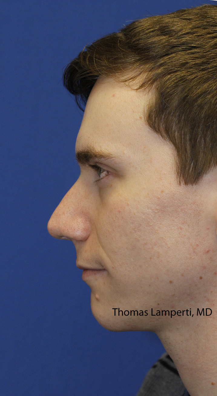 Rhinoplasty Before Left Profile