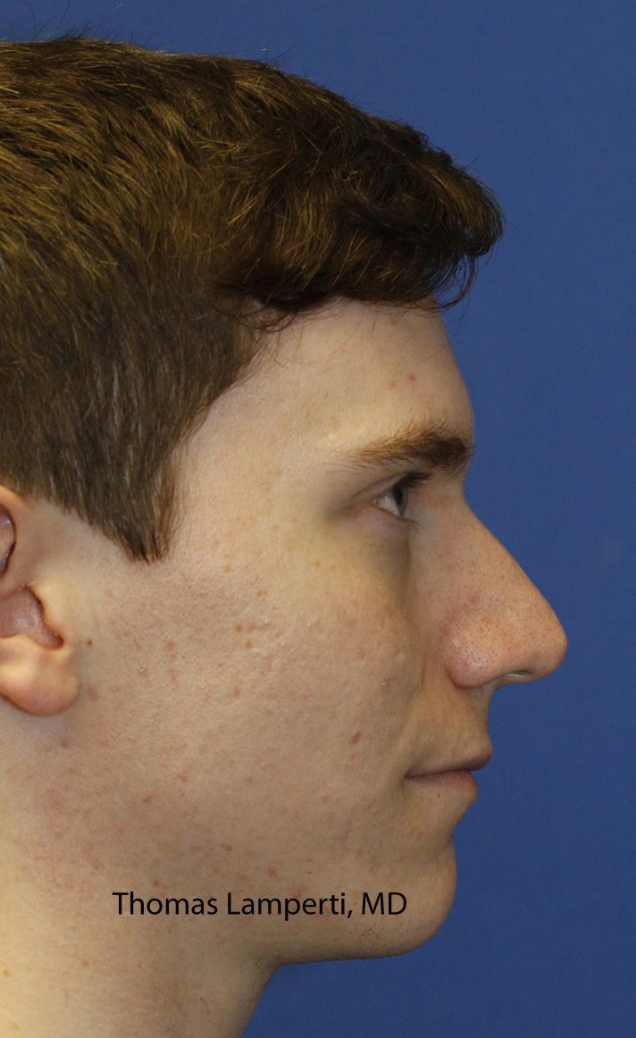 Rhinoplasty Before Right Profile
