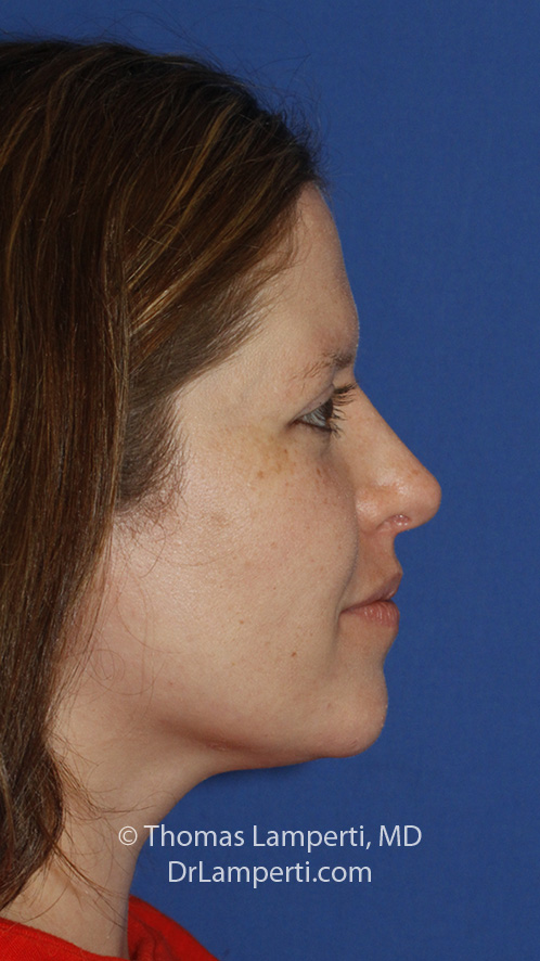 hinoplasty R Profile After