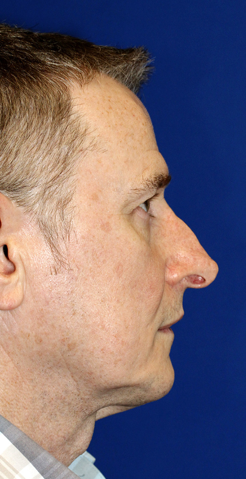 Profile before revision rhinoplasty photo to correct hanging columella and alar retraction