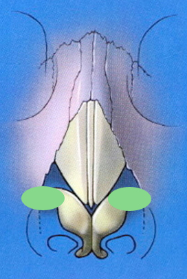 Schematic showing were bilateral alar batten grafts are placed Schematic showing were bilateral alar batten grafts are placed