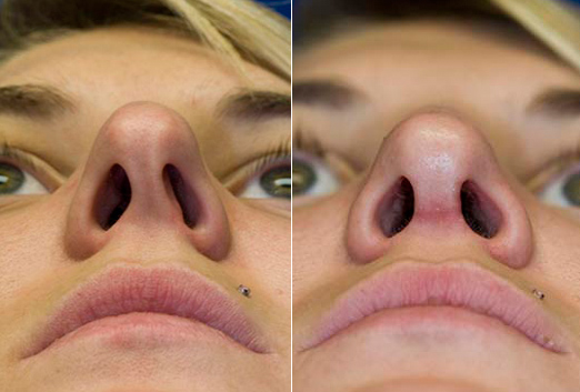 Caudal septal deviation before and after caudal septal reconstruction Caudal septal deviation before and after caudal septal reconstruction