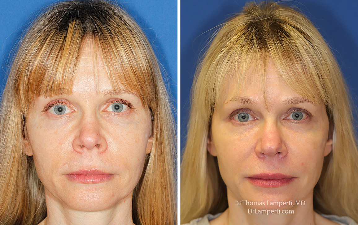Revision rhinoplasty patient 19 before and after Y-V advancement alar base reduction to treat flaring