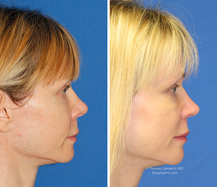 Revision rhinoplasty patient 19 right profile before and after to increase tip projection