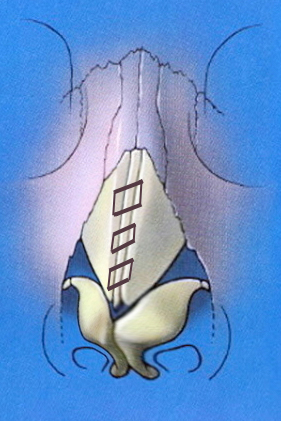 clocking suture schematic