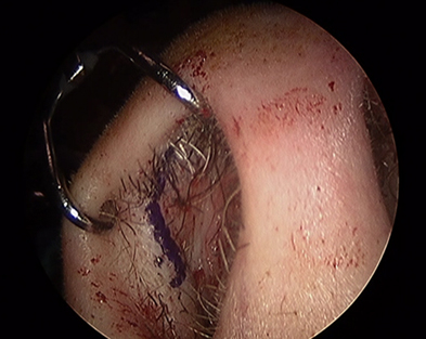 closed-incision-to-place-alar-batten-grafts.jpg