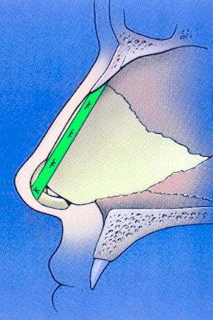 Extended spreader graft schematic profile Extended spreader graft schematic profile