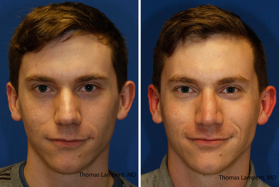 Patient 43 bulbous nose rhinoplasty with thick skin and wide nasal domes.jpg