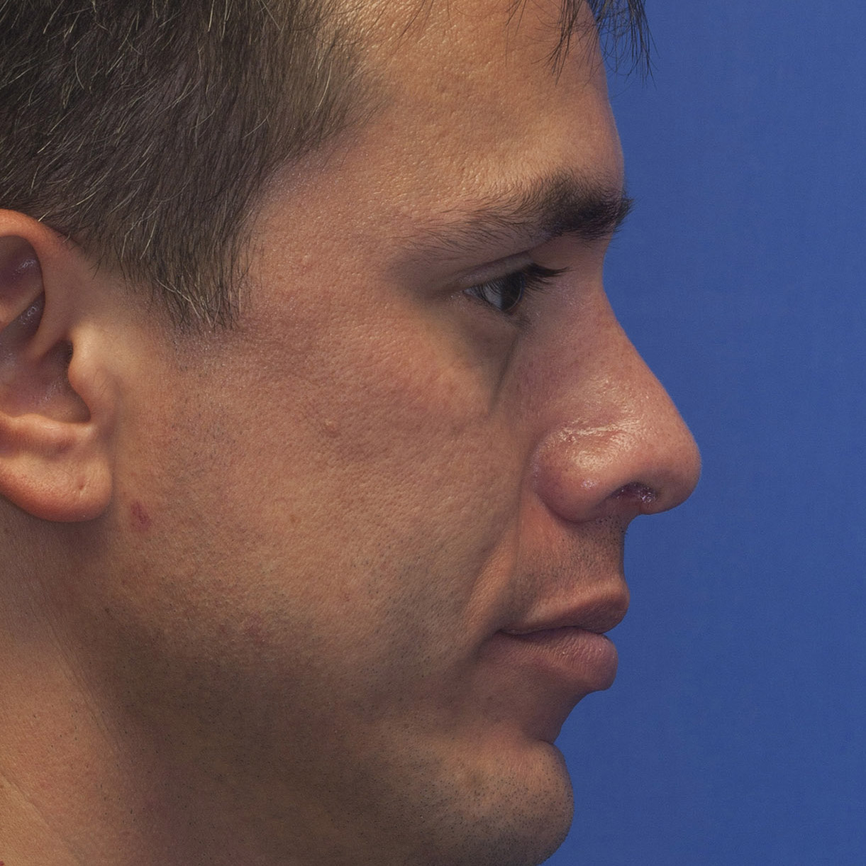 pug nose surgery upturned tip rhinoplasty in seattle rhinoplasty surgeon pug nose surgery upturned tip rhinoplasty in seattle rhinoplasty surgeon