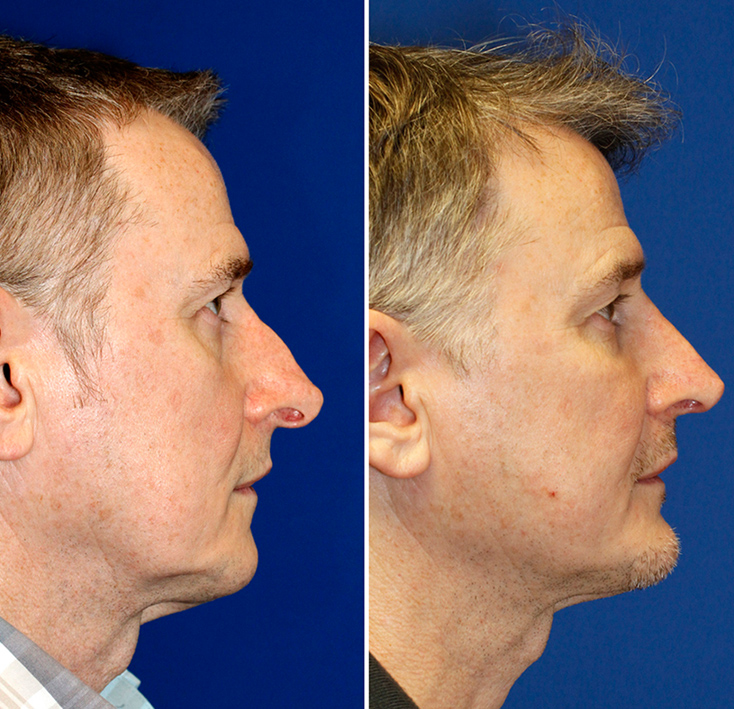 Before and after revision rhinoplasty photos to treat hanging columella and alar retraction