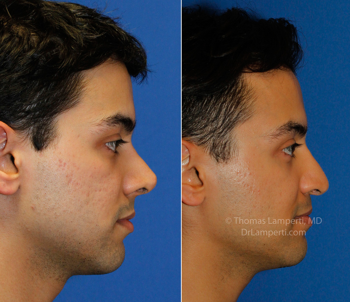 Revision rhinoplasty patient 15 right profile montage before and after photo