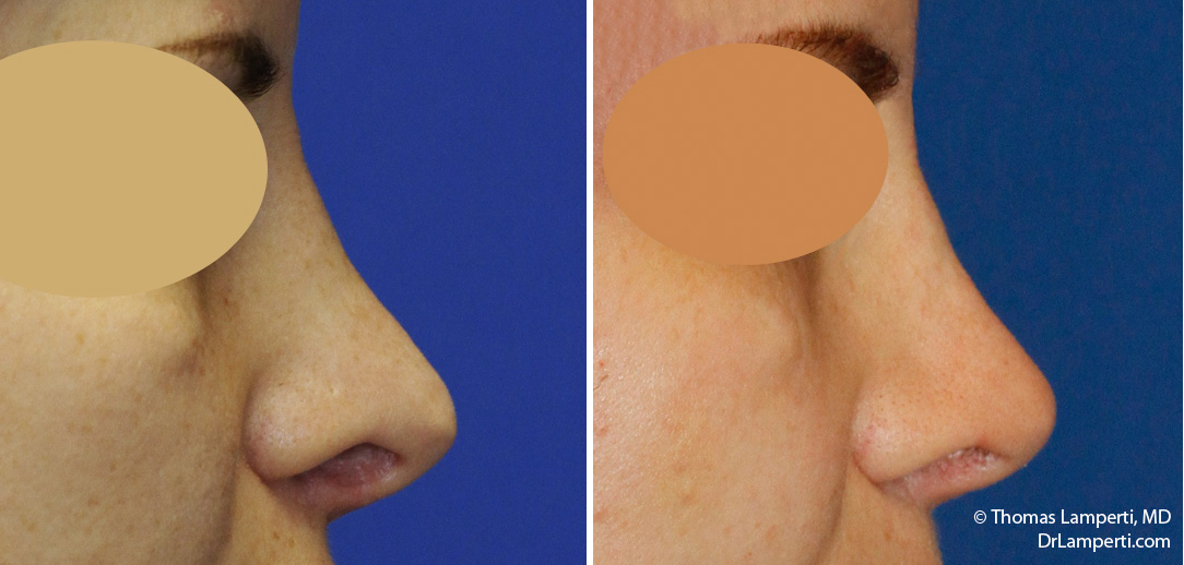 Revision rhinoplasty patient 18 pollybeak repair