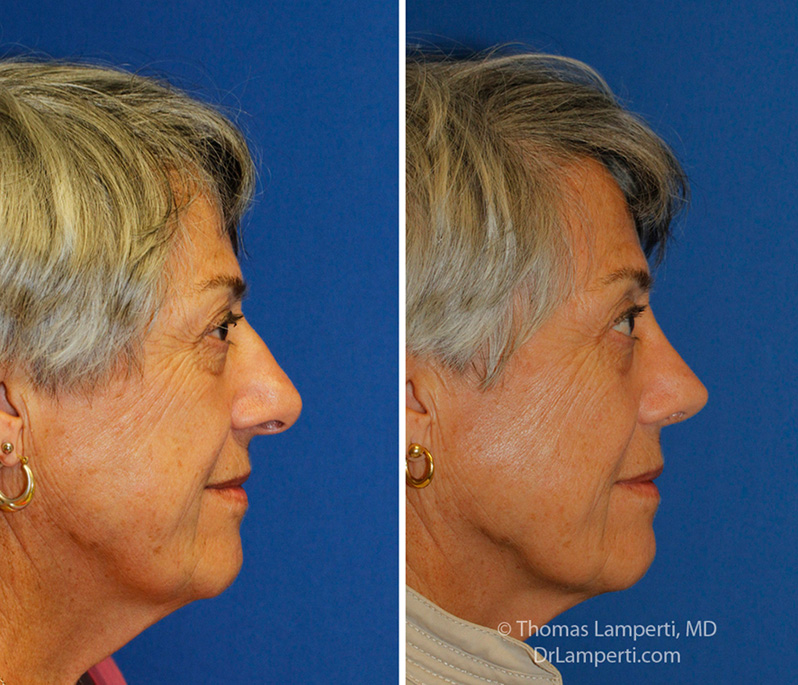 Rhinoplasty patient 56 hanging columella repair before and after