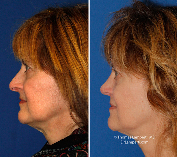 Rhinoplasty patient 59 hanging columella repair before and after