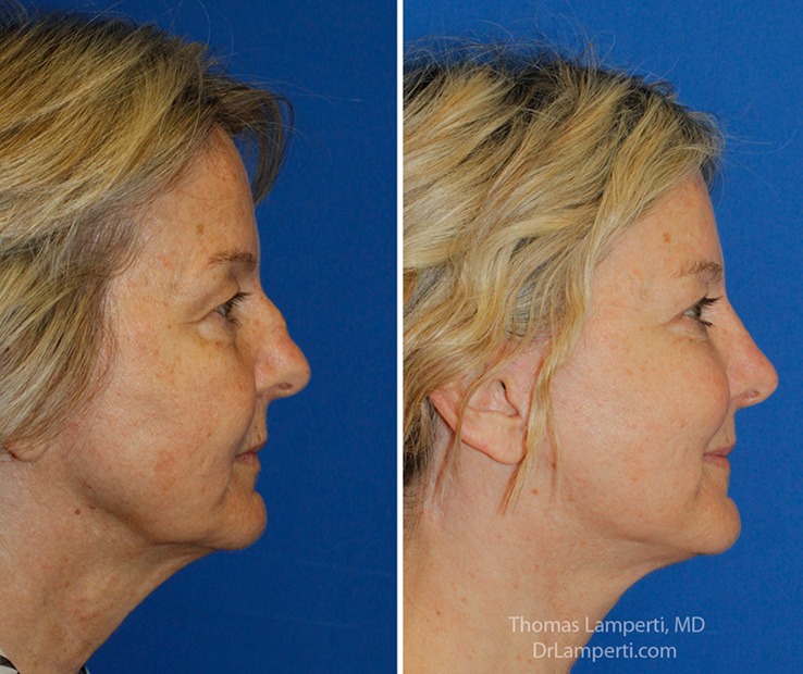 Rhinoplasty 59 R profile saddle nose repair before and after photo