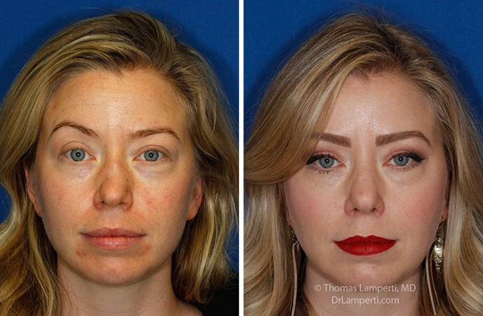 Rhinoplasty patient 63 bbefore and after crooked nose repair motnage