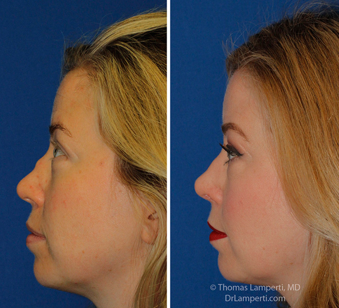 Rhinoplasty patient 63 before and after saddle nose repair profile view
