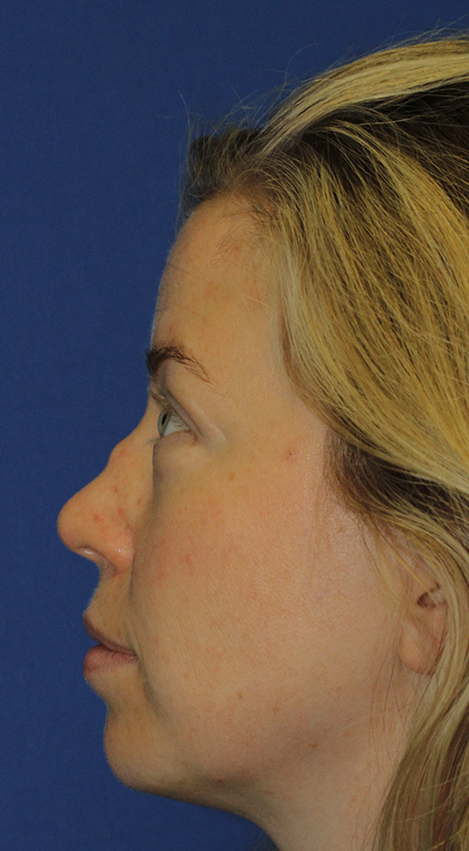 Wegener's saddle nose rhinoplasty patient 63 before left profile