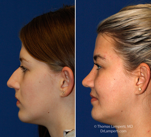 Rhinoplasty patient 64 bridge hump removal before and after