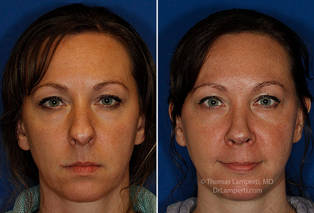 Rhinoplasty patient 67 before and after frontal boxy trapezoidal tip repair