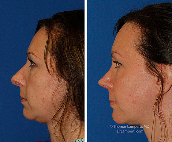Rhinoplasty patient 67 before and after hanging columella repair