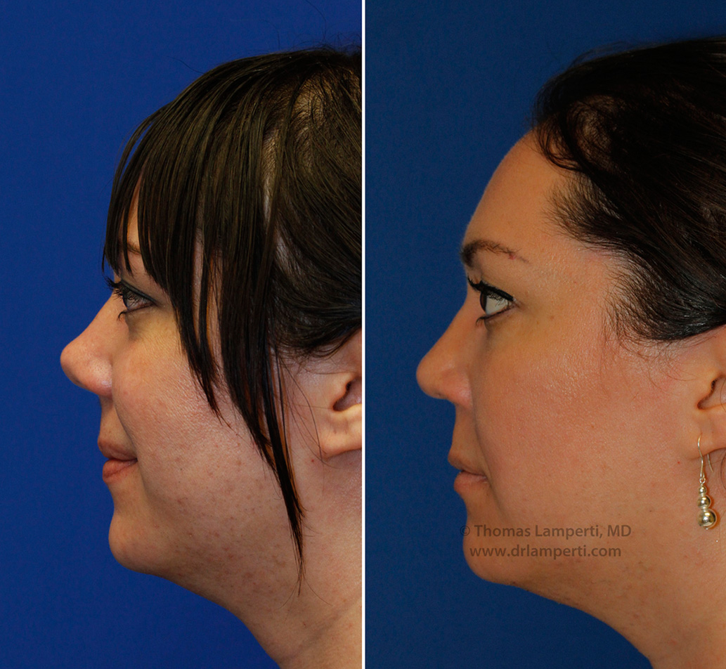 Rhinoplasty patient 46 upturned nose repair profile before and after photo
