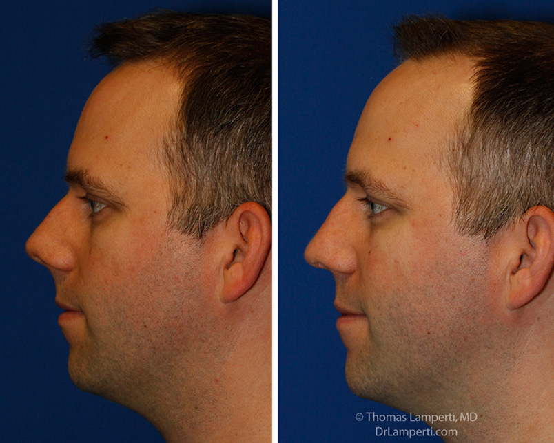 rhinoplasty patient 55 L profile upturned tip repair