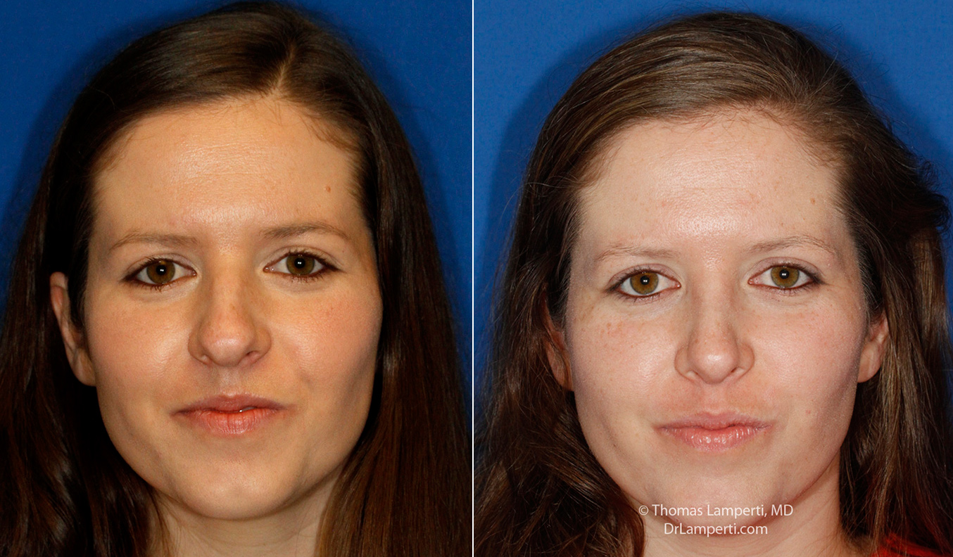 Rhinoplasty patient 60 boxy tip repair before and after photos