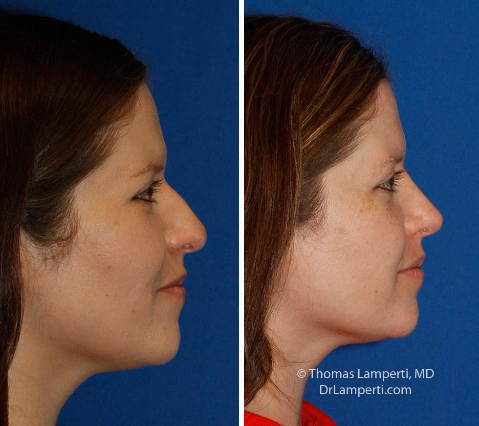 Rhinoplasty patient 60 right profile before and after bridge hump takedown