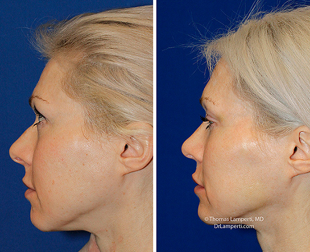 Rhinoplasty patient 68 profile before and after photos