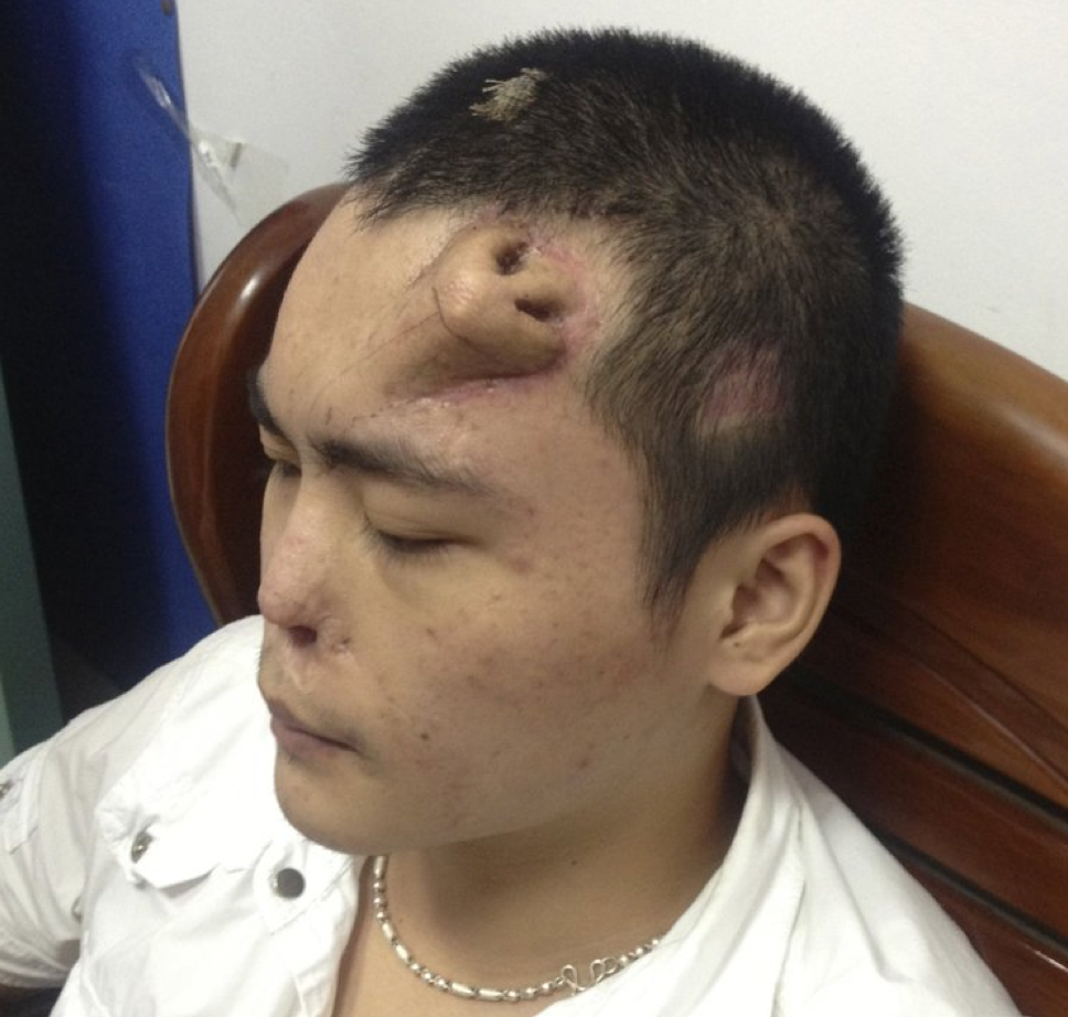 Chinese man with a new nose built on his forehead to replace his severely injured nose