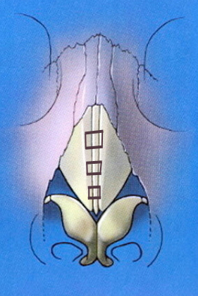 straightened-middle-and-lower-third-after-clocking-sutures.jpg