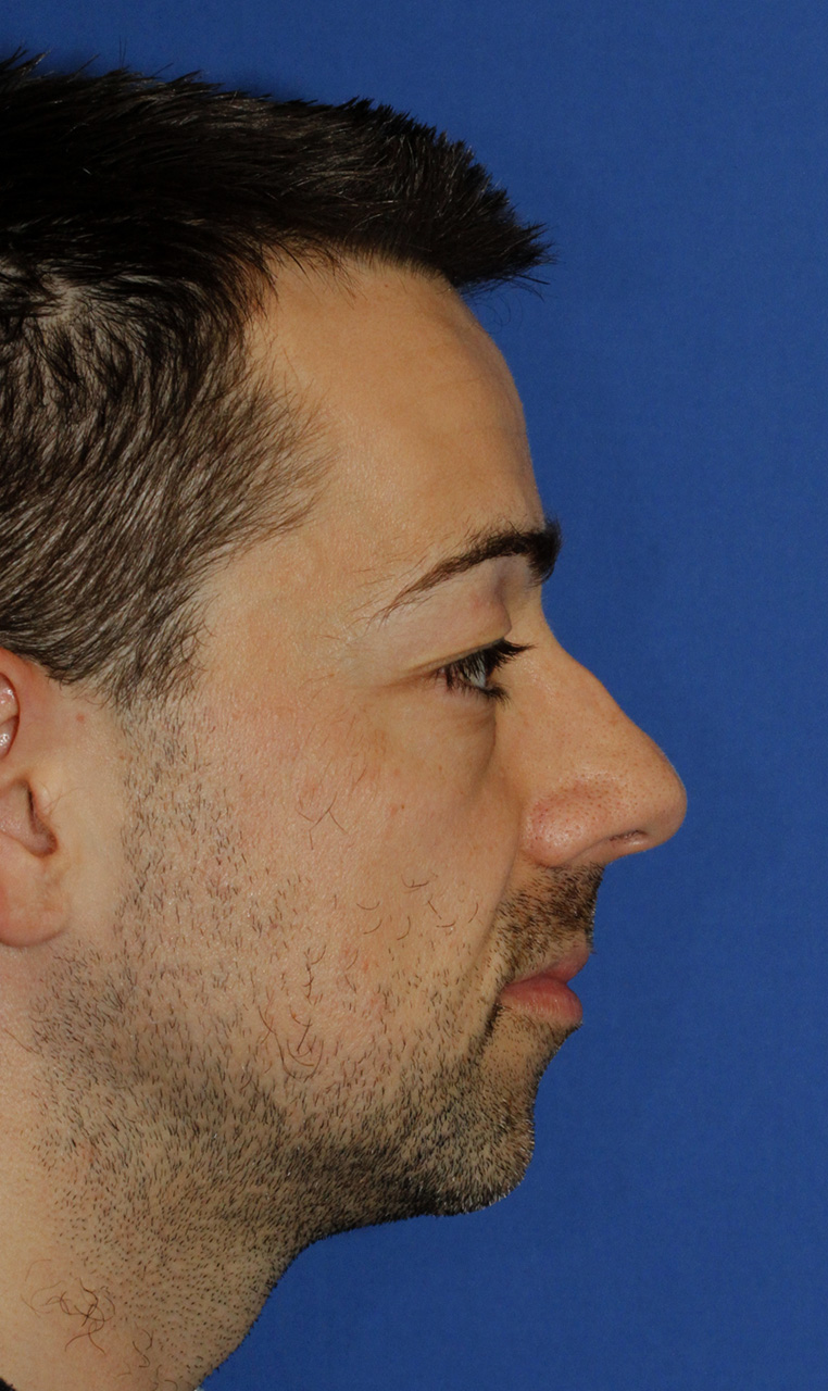 Chin Implant Before R Profile