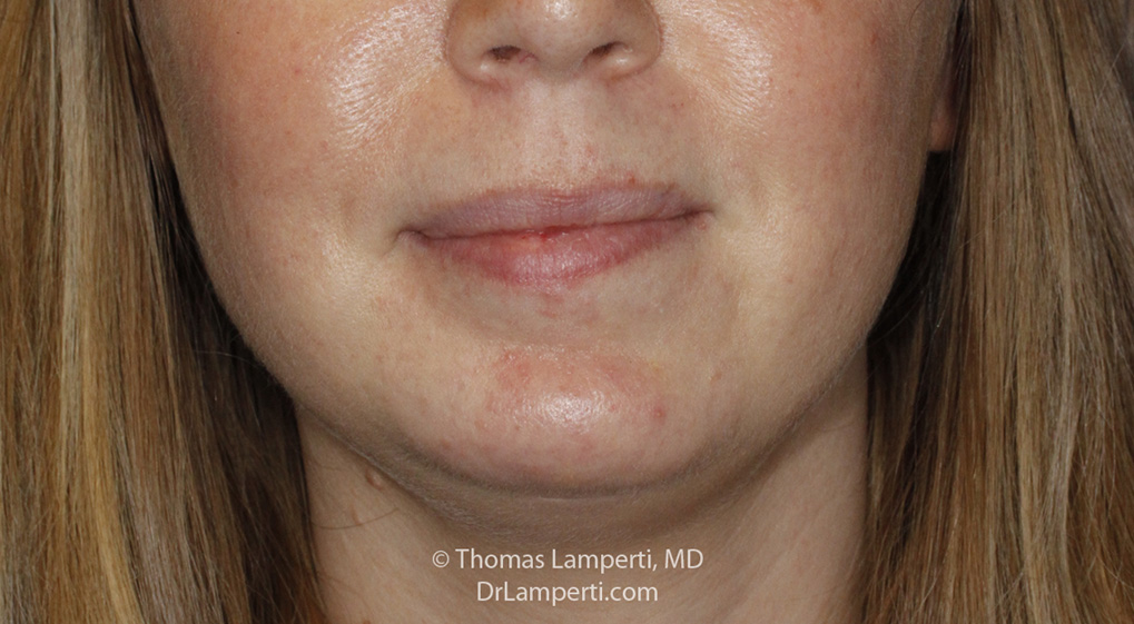 Chin Implant After Frontal