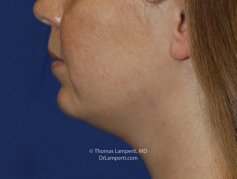 Chin Implant After L Profile