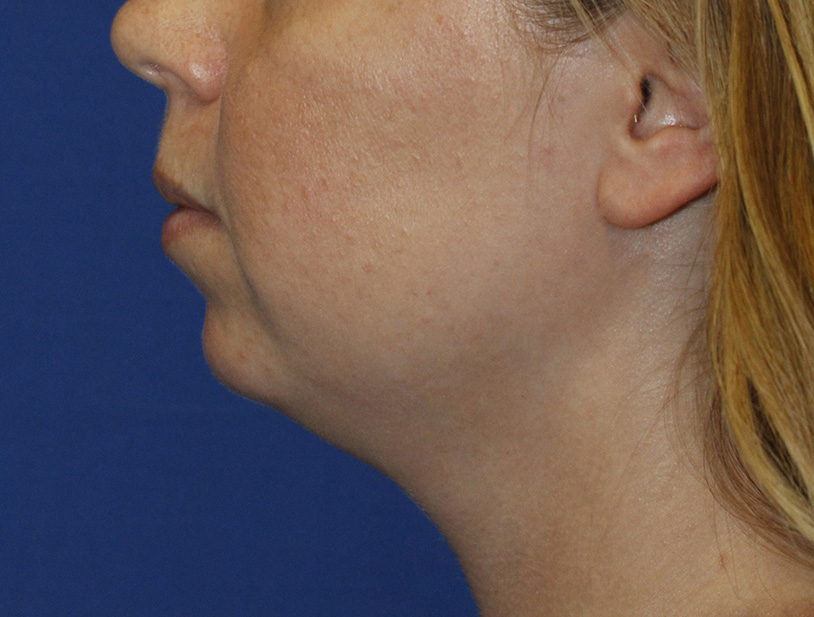 Chin Implant Before L Profile