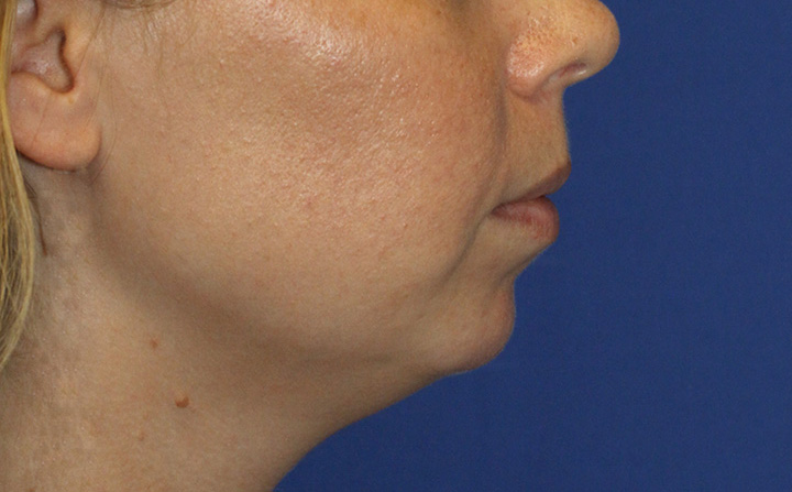 Chin Implant Before R Profile